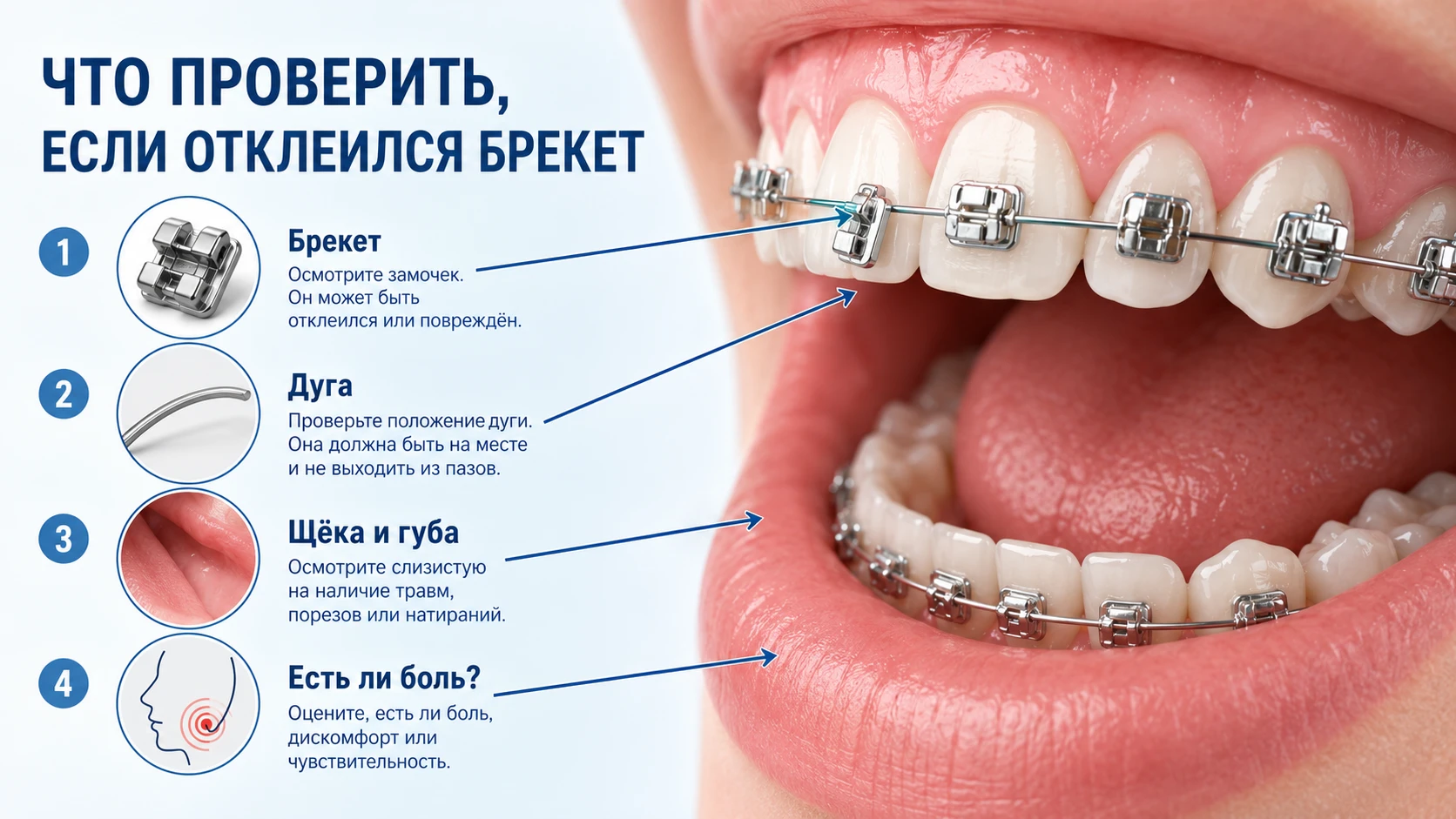Что проверить, если отклеился брекет