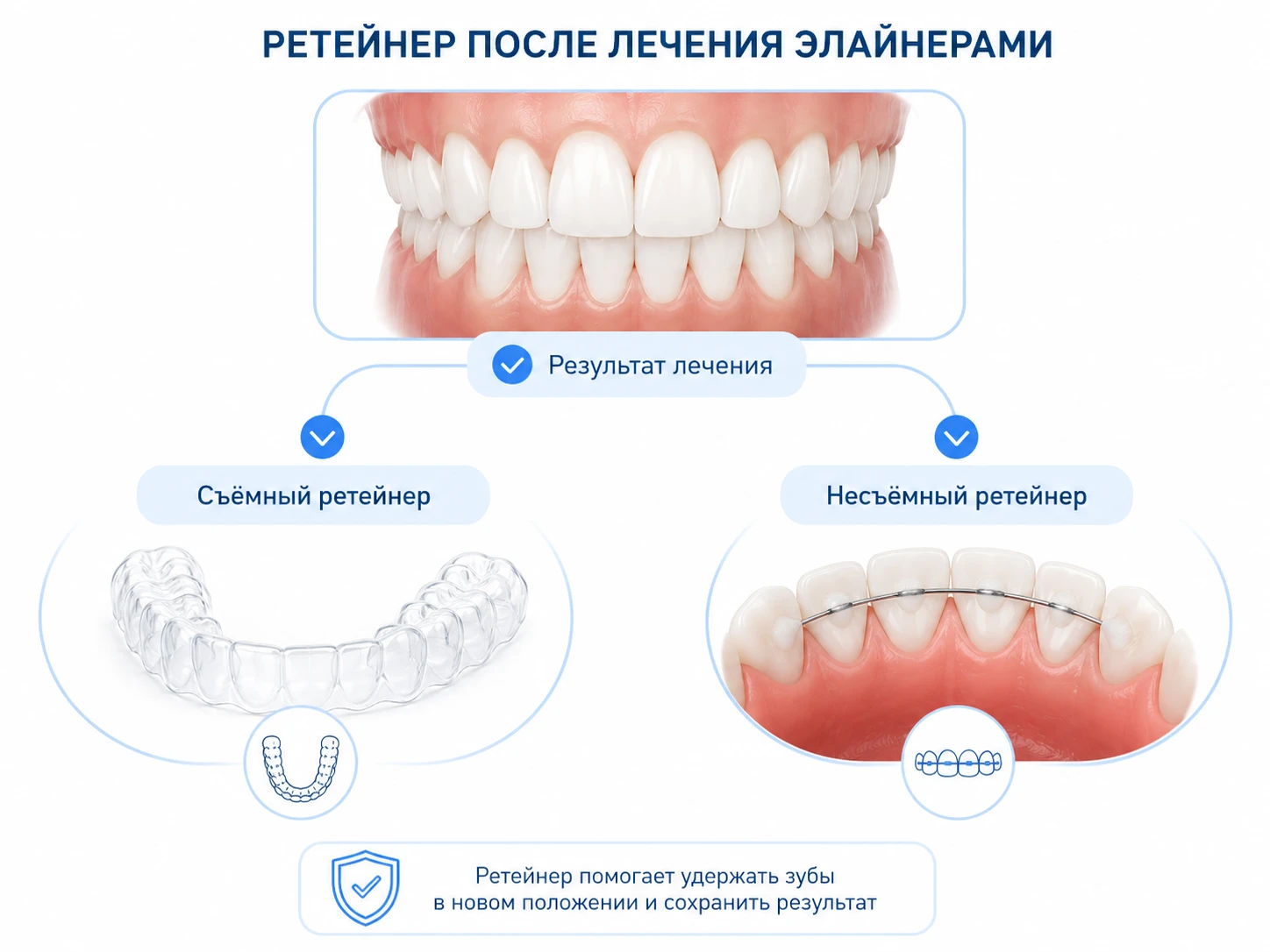 Схема ретейнера после лечения элайнерами