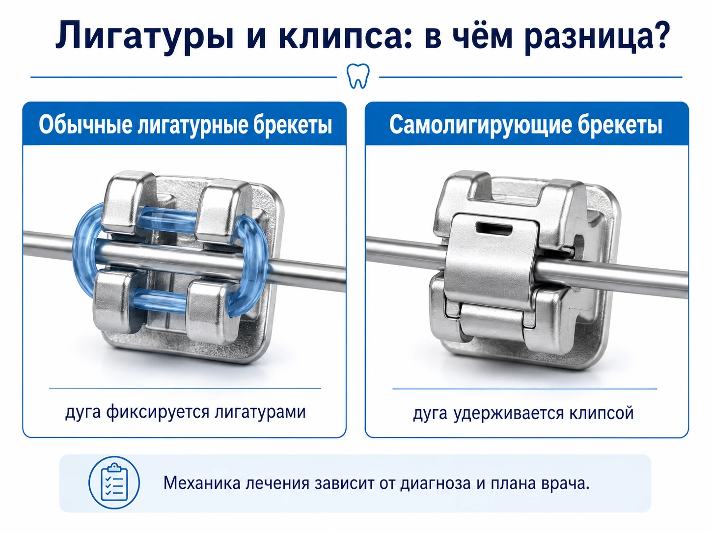 Схема отличия обычных лигатурных брекетов от самолигирующей клипсы