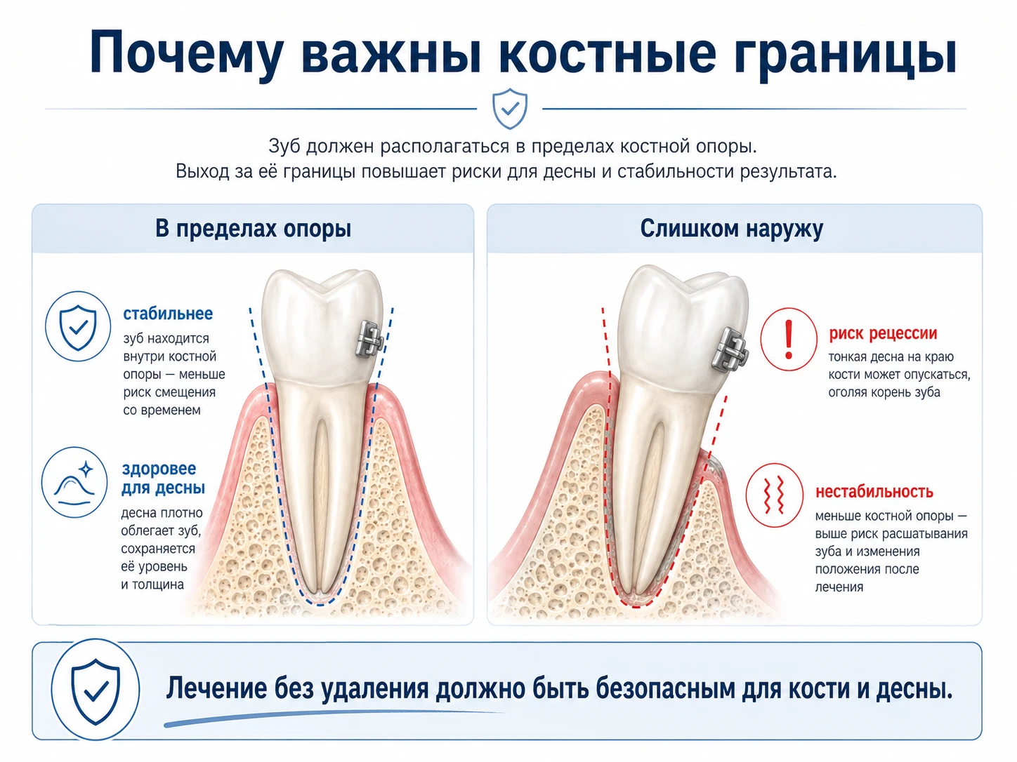 Схема безопасного положения зуба в пределах костной опоры